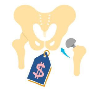 Average Costs of Hip Replacement Surgery