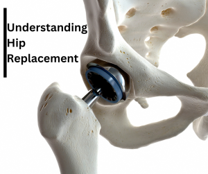 Understanding Medicare and Hip Replacement Coverage